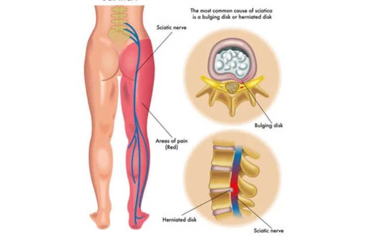 Sciatica